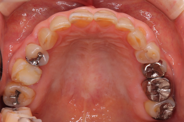 上顎・治療前