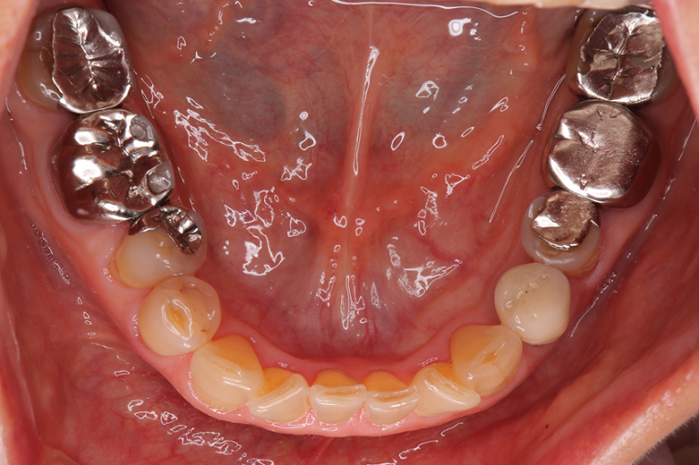 下顎・治療前