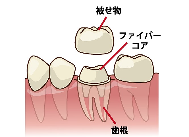 ファイバーコア＜土台＞