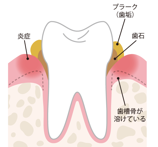 歯石を放置すると