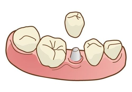 インプラントとブリッジ・入れ歯の違い