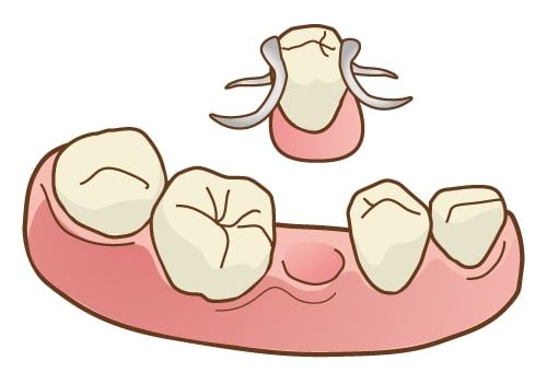 インプラントとブリッジ・入れ歯の違い