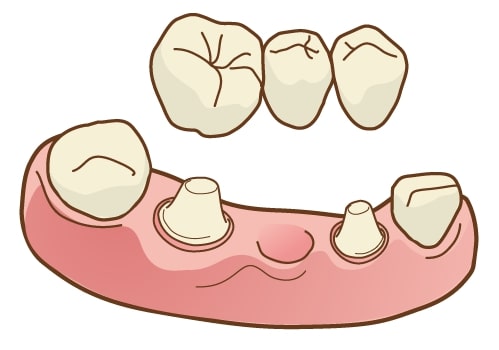 インプラントとブリッジ・入れ歯の違い