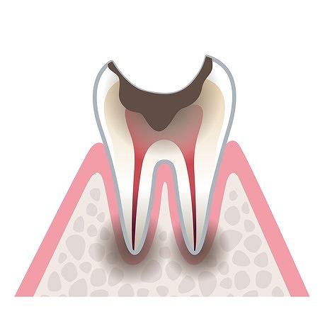 虫歯を放置してしまった