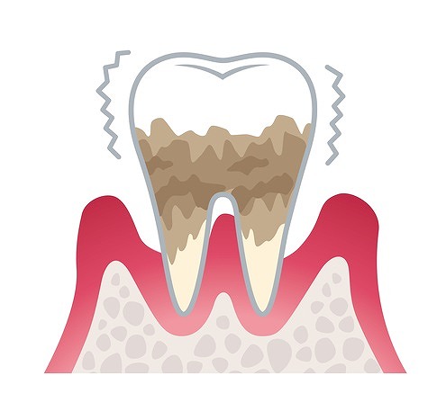歯周病を放置してひどくなった