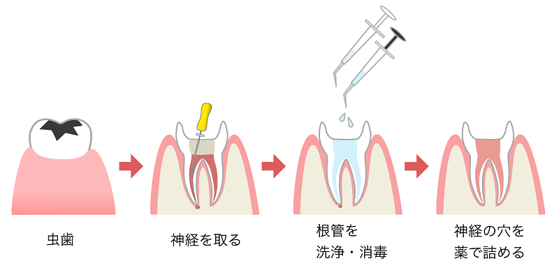 歯の神経の治療「根管治療」