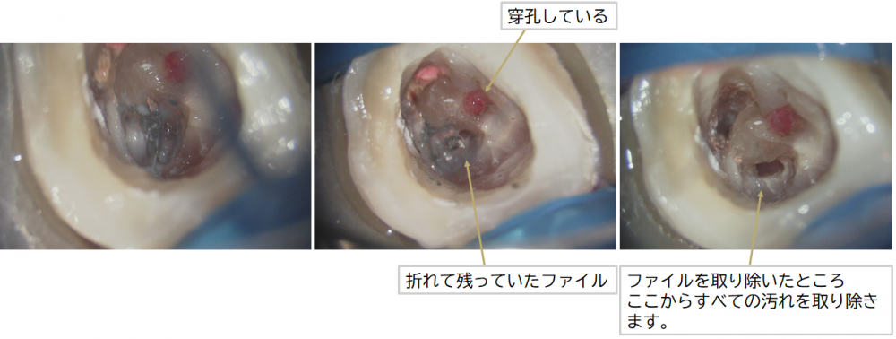 ファイル除去