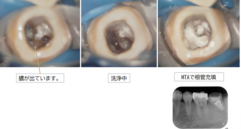 歯の根っこを再生 根管治療後の痛みはいつまで 対処法 さつきデンタルクリニック