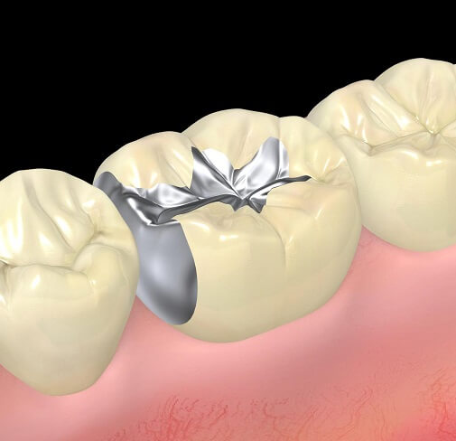 銀歯（金属）にしたくない奥歯の治療｜愛知県名古屋市・名古屋RD歯科 ...