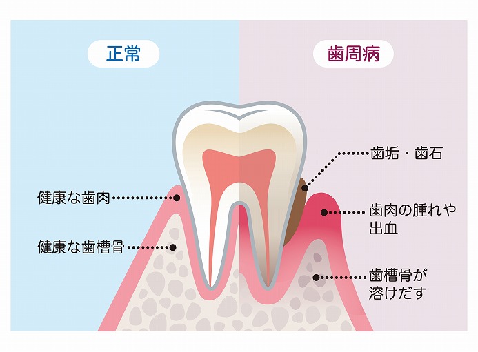 歯茎 腫れ 自然 に 治る