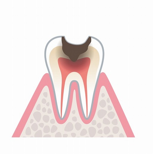 歯の神経が細菌感染を起こしている(不可逆性歯髄炎)