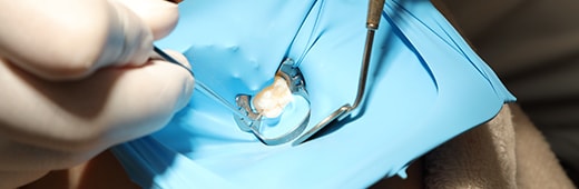 不用歯の抜歯・歯髄幹細胞の採取と培養