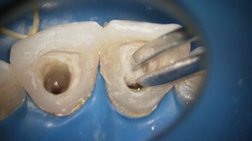 歯髄幹細胞移植