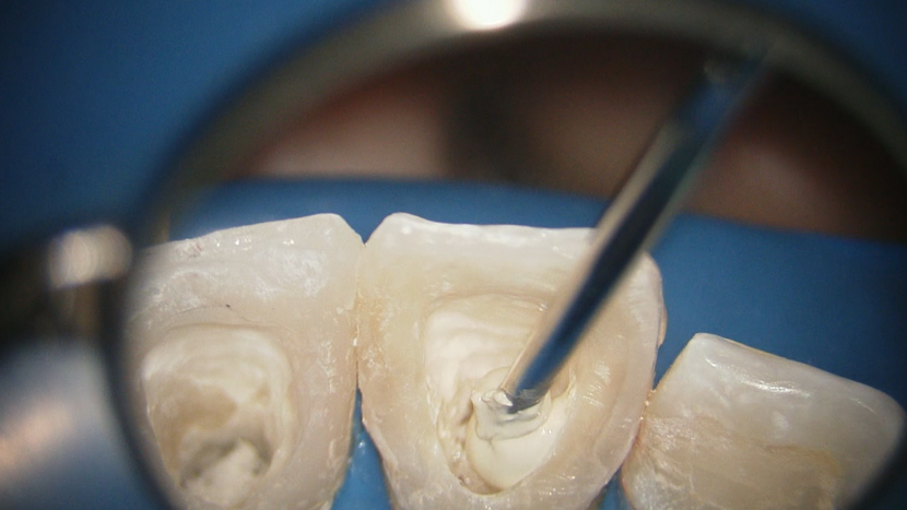 歯髄幹細胞移植