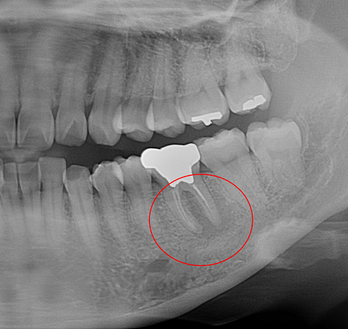 レントゲンで見ると、根の周りが黒くなっています。